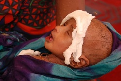 A severely malnourished child at Hilaweyn health facility, being held by his mother. VOA - P. Heinlein